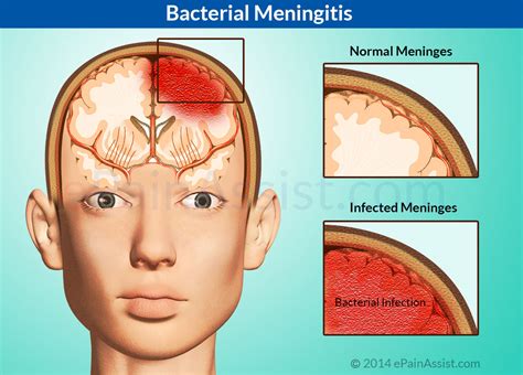 Meningitis 뜻